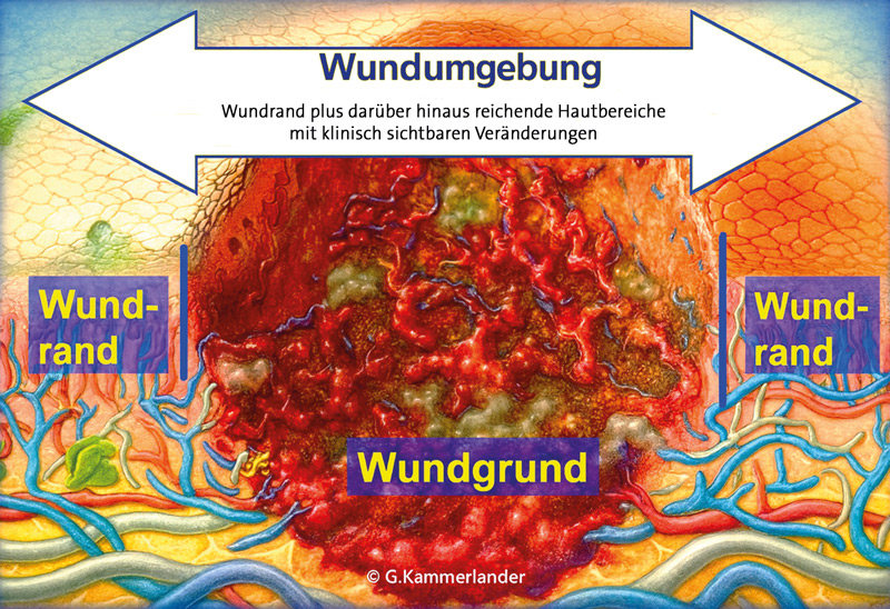 Schematische-Darstellung-einer-schwer-heilenden-Wunde